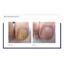 Load image into Gallery viewer, Footlogix Anti-Microbial Toe Tincture #7T