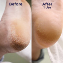 Load image into Gallery viewer, Footlogix Callus Combo

